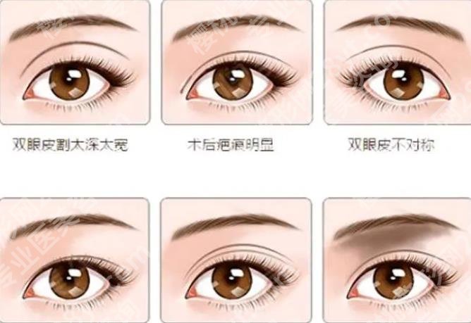 上海九院割双眼皮在哪个院区?苏薇洁vs杨娴娴谁的技术好?