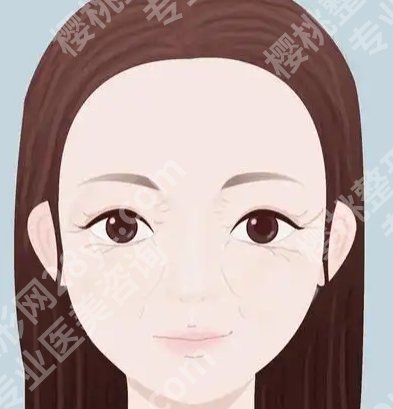 薇旖美打眼周细纹多久见效?常见问题和注意事项更新