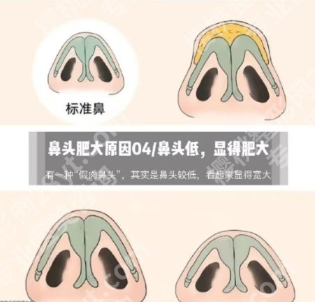 北京八大处鼻翼缩小价格曝光!1.4w元起,赵延勇、杨明勇等性价比挺高
