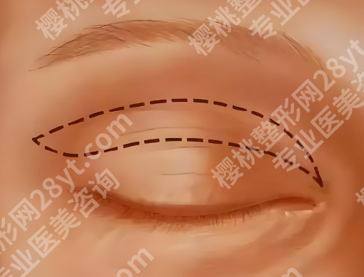 侯典举医生双眼皮失败案列怎么样?附有医生介绍和修复案例优选