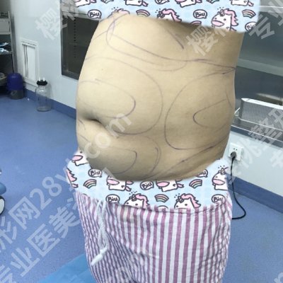 2025广州海峡抽脂价格高吗?低至10000元起!附医院亮点!