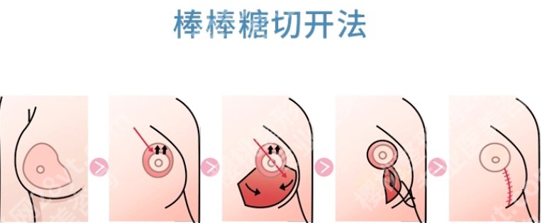 上海乳房下垂矫正要花多少钱?矫正手术后要注意什么?