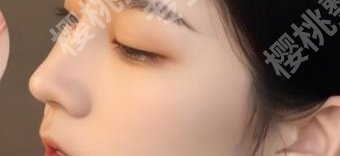 深圳北大医院隆鼻价格贵不贵?何君君vs李天石技术对比!