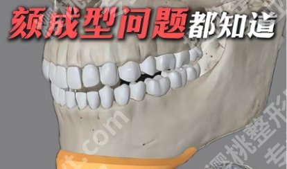 首口颏成型费用贵不贵?全新收费标准更新!戳进来看