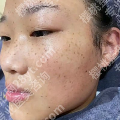 湘潭中心医院点阵激光多少钱一次?低至4000元起!附真实案例!