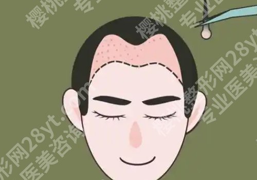 医学科学院整形外科医院植发费用是多少?低至10000元起!附优势信息!