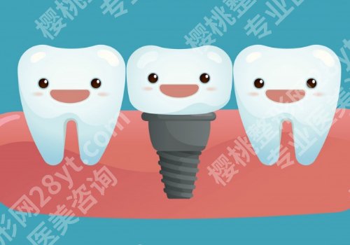 北京协和医院种植牙价格是多少?低至10000元起!内附新版价格表!