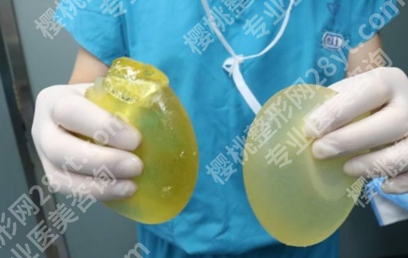 北京八大处假体隆胸取出价格25年更新,技术优势_真人案例曝光!