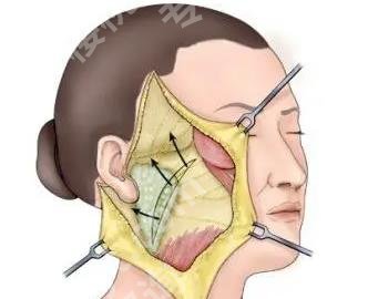 广州王世虎拉皮怎么样?戳进来看真实的口碑点评!术后小tips