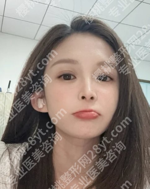 申霄医生做双眼皮修复怎么样?审美独特、技术成稳!