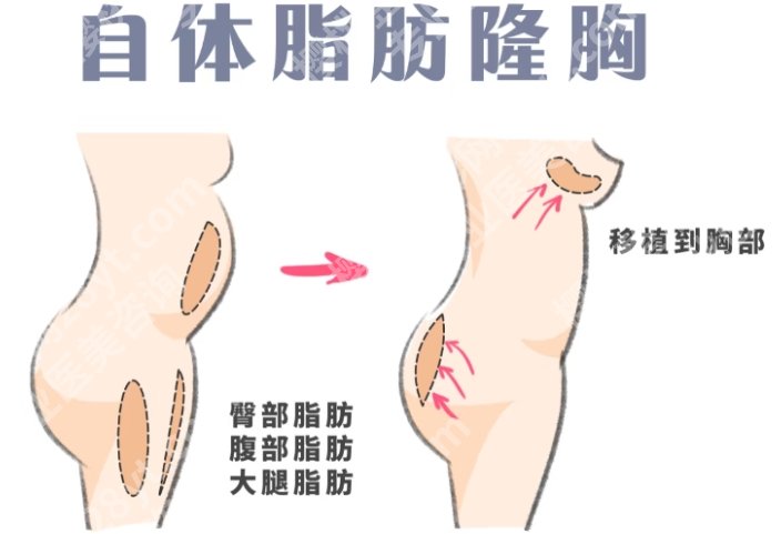 烟台自体脂肪丰胸医院排名更新!医院具体内容详情!