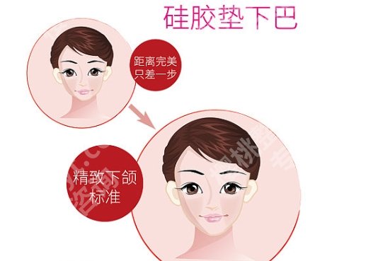 上海九院垫下巴多少钱?医院具体详细介绍!附相关科普知识