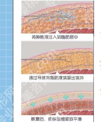 西安吸脂医生排名名单!医生技术口碑在线查看!