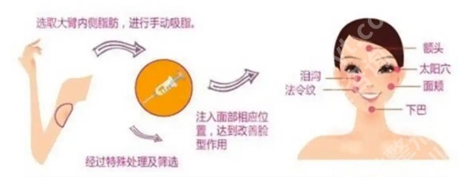 上海九院脂肪填充全脸多少钱?近期价格表明细参考!速速码住