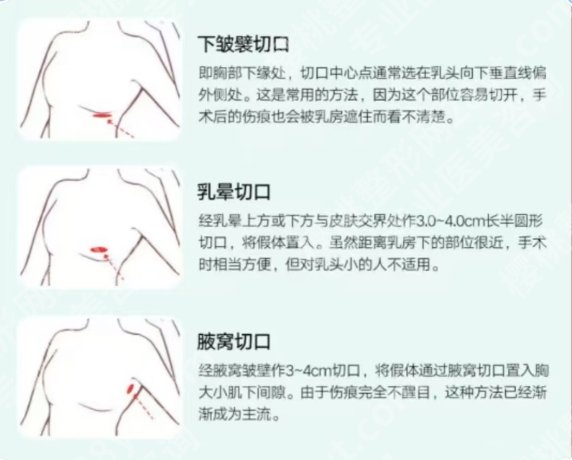 南方医院脂脂肪丰胸怎么样?医院技术力量雄厚!环境优雅温馨