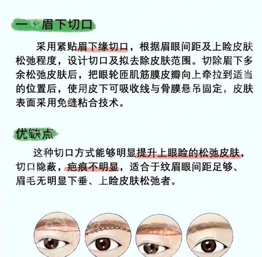 广州韩妃做提眉*好的医生?挂号攻略|案例分享!