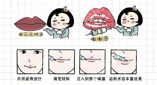 上海玻尿酸丰唇需要多少钱?医院价格表单新鲜出炉!