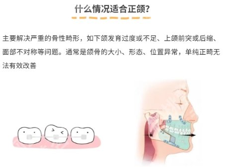 北京深覆合正颌手术要多少钱?医院价目表参考!速速码住
