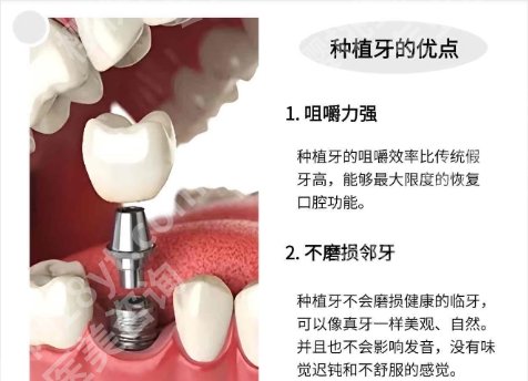 常州牙齿种植一般要多少钱?医院物美价廉!案例分享