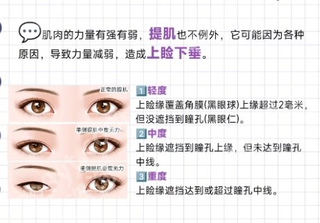 徐晓斐双眼皮修复的怎么样?附项目疑问解答!
