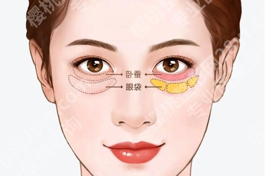 北医三院祛眼袋好吗?医院技术提升!口碑点评