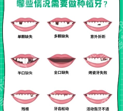 周口牙齿种植医院2025年名单分享来了!周口市中心医院|中医院等都很不错!