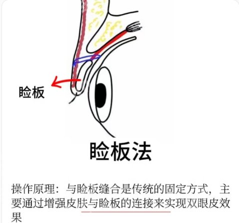 珠海割双眼皮多少钱?都是5000元左右起!价目表一览参考!