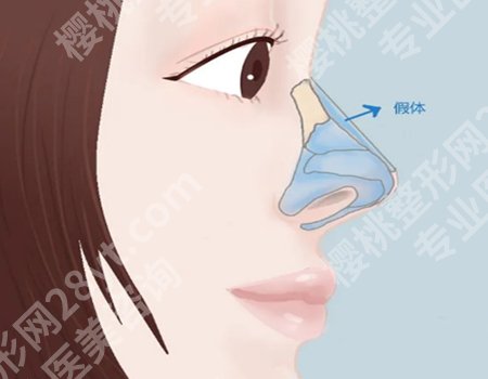 假体隆鼻能终身不取出?项目科普三大点了解