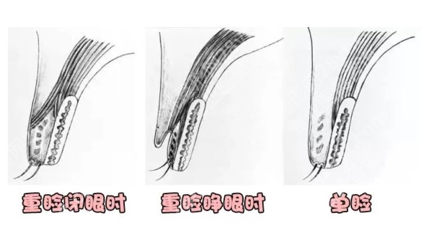 佀同帅全切双眼皮案例及医生具体资料!近期案例反馈!