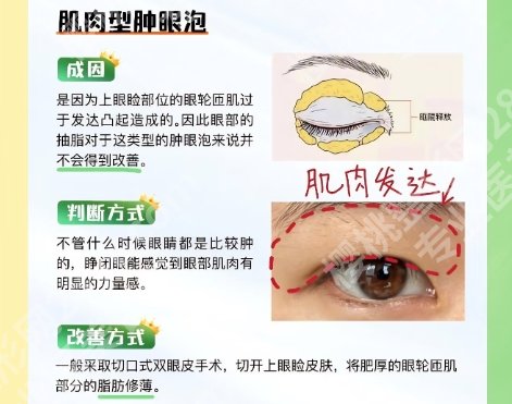 佀同帅全切双眼皮案例及医生具体资料!近期案例反馈!