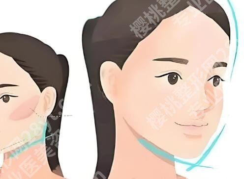 颧骨内推恢复期多久?全流程揭秘,详情咨询在线看
