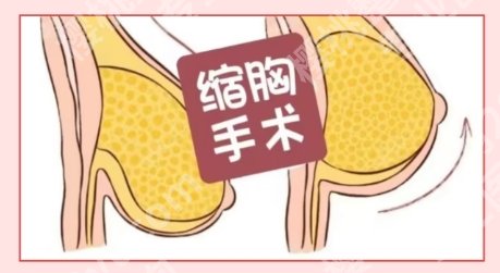 华东医院缩胸手术费用大概是14000元左右起！医院技术靠谱！
