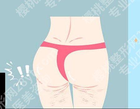 自体脂肪丰臀:一次就能拥有理想臀型吗?戳进来详细看