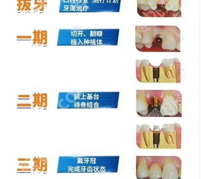 南方医科大学口腔医院种牙哪个医生好?刘长虹、刘卫平实力靠谱!