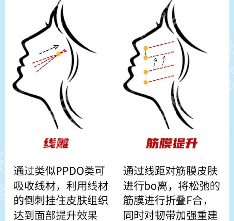 唐都医院筋膜提升术怎么样?医院技术特别有水平|项目技术也很棒!