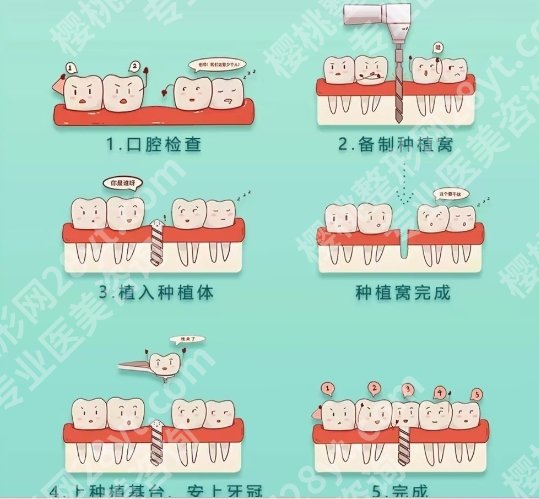济宁人民医院种牙多少钱?2025版项目收费明细参考!
