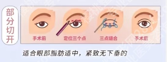 南方医科大学深圳医院双眼皮和南方医院哪个好?医院具体资料信息!