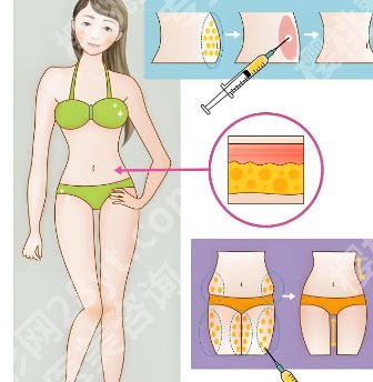 南京美莱吸脂怎么样?明星项目以及医院详细盘点!点击浏览