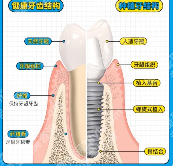 深圳牙齿种植价格如何?医院价格表一览!收藏再看