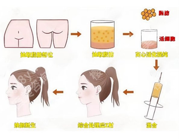 北京协和医院脂肪填充医生团队资源!附用户口碑!