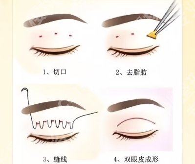 浙一医院双眼皮修复专家有哪些?一键了解专家详细信息!
