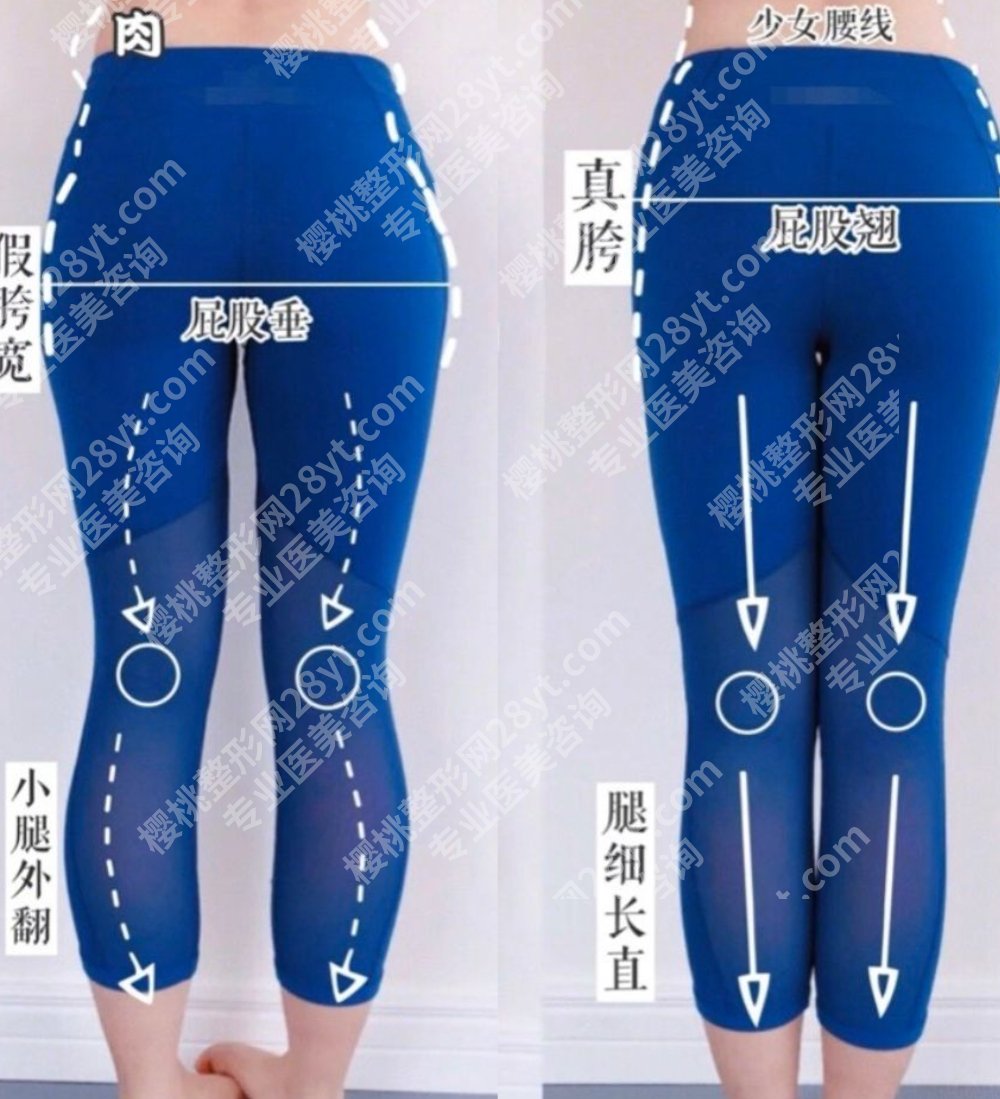 o型腿部塑形医美,不是天生笔直,也能后天修饰