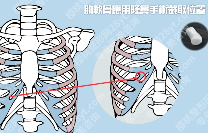 肋软骨隆鼻可以维持一辈子吗?效果长久≠一劳永逸,时间问题没那么简单