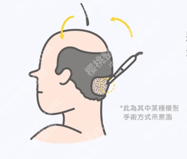 青岛植发医院排名,真人案例+实操体验,避坑不求人
