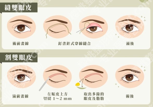 双眼皮一个月和三个月,恢复进度条全解析,新手别被前期状态吓退