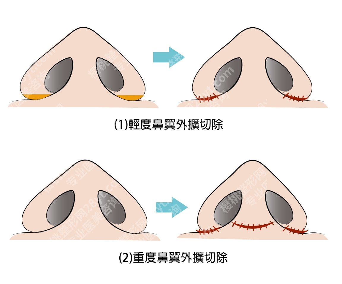切鼻翼手术风险大吗?术前必须知道的注意事项,不看后悔系列