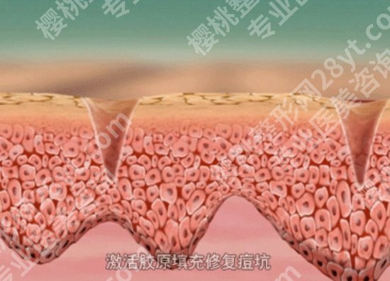 做点阵激光多久可以恢复?熬过这14天,皮肤真的像新生!恢复指南