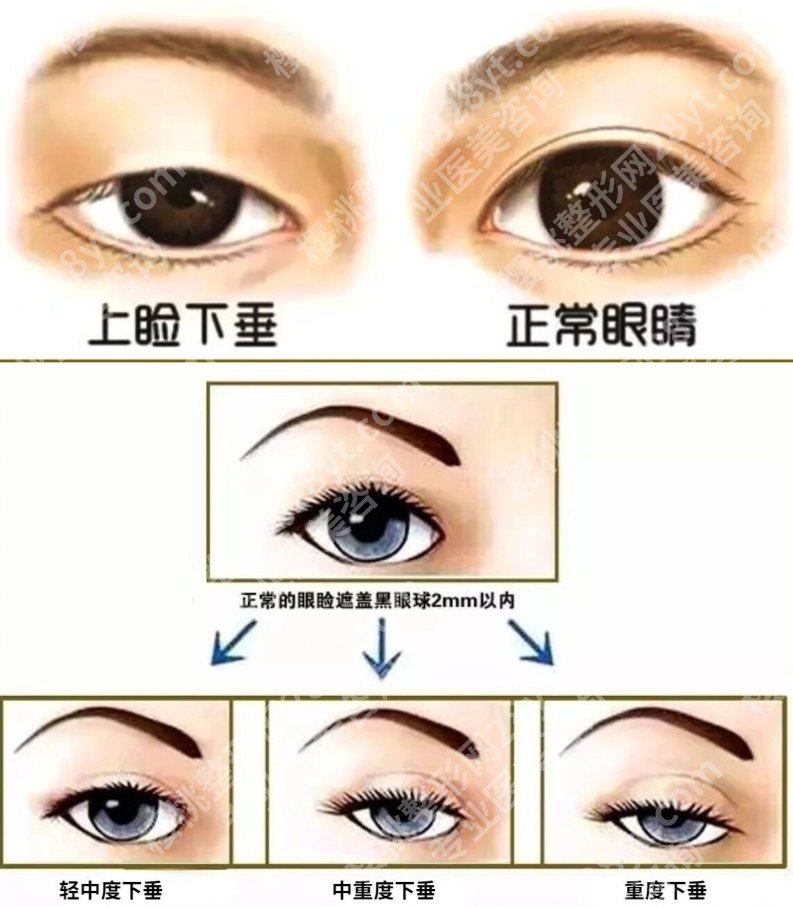 上睑下垂矫正和割双眼皮,一个是锦上添花,一个是修复bug,搞懂再上手!