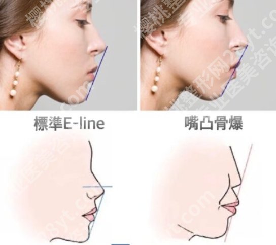骨性嘴凸和牙性嘴凸怎么区别,笑起来怪怪的?先别自卑,可能只是“结构出问题”!