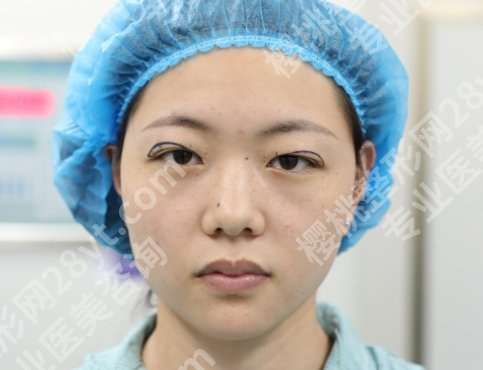 双眼皮修复是重新割吗?“翻车”后还能逆袭?修复操作了解一下!